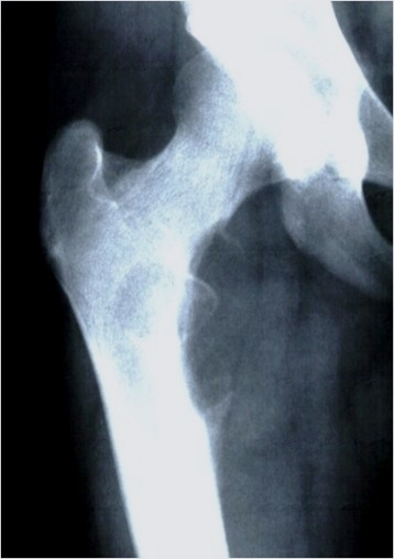 Ewings Tumour Proximal Femur